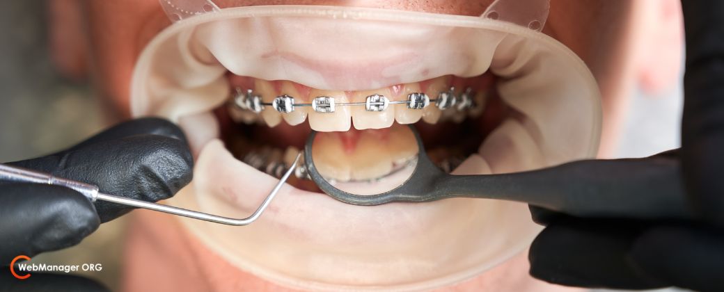 אפשר לעשות אינויזליין גם אם עברתי יישור בעבר? - ניתן לראות פה מחייך של אישה אשר בו מתקינים מתקן יישור שיניים ובצד שמאל למטה לוגו אתר חח blog.webmanager